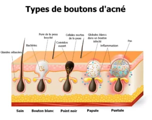 Différentes boutons d'acné | CBD LOVELY