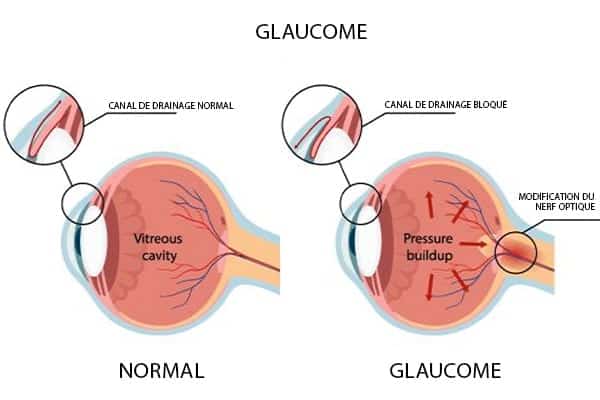Oeil atteint par un glaucome | CBD LOVELY