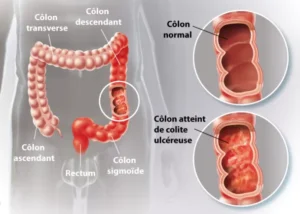 Comprendre la rectocolite hémorragique | CBD LOVELY