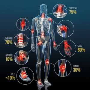 Localisation de l'arthrose dans les corps | CBD LOVELY