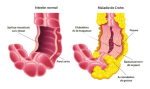 maladie de Crohn | CBD LOVELY