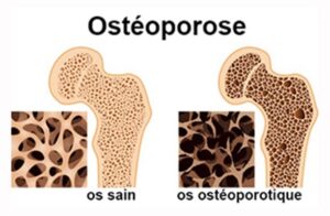 osteoporose