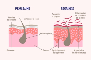 psoriasis cutané | CBD LOVELY Paris