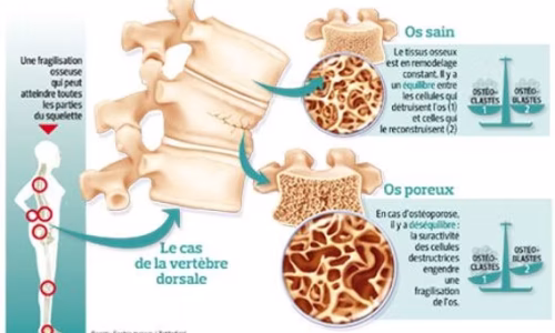 ostéoporose aidée par le CBD | CBD LOVELY Paris